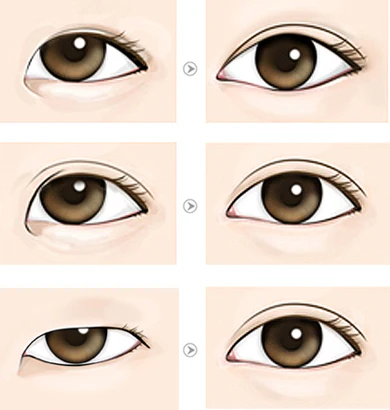 Eye Charm Eyelid tape New Queen Clear 3 mm